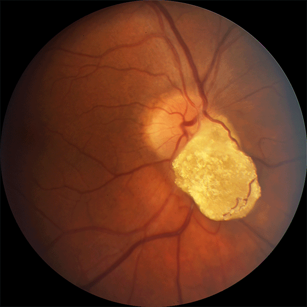 Sustained Disease Control with Eylea 8mg POAP image